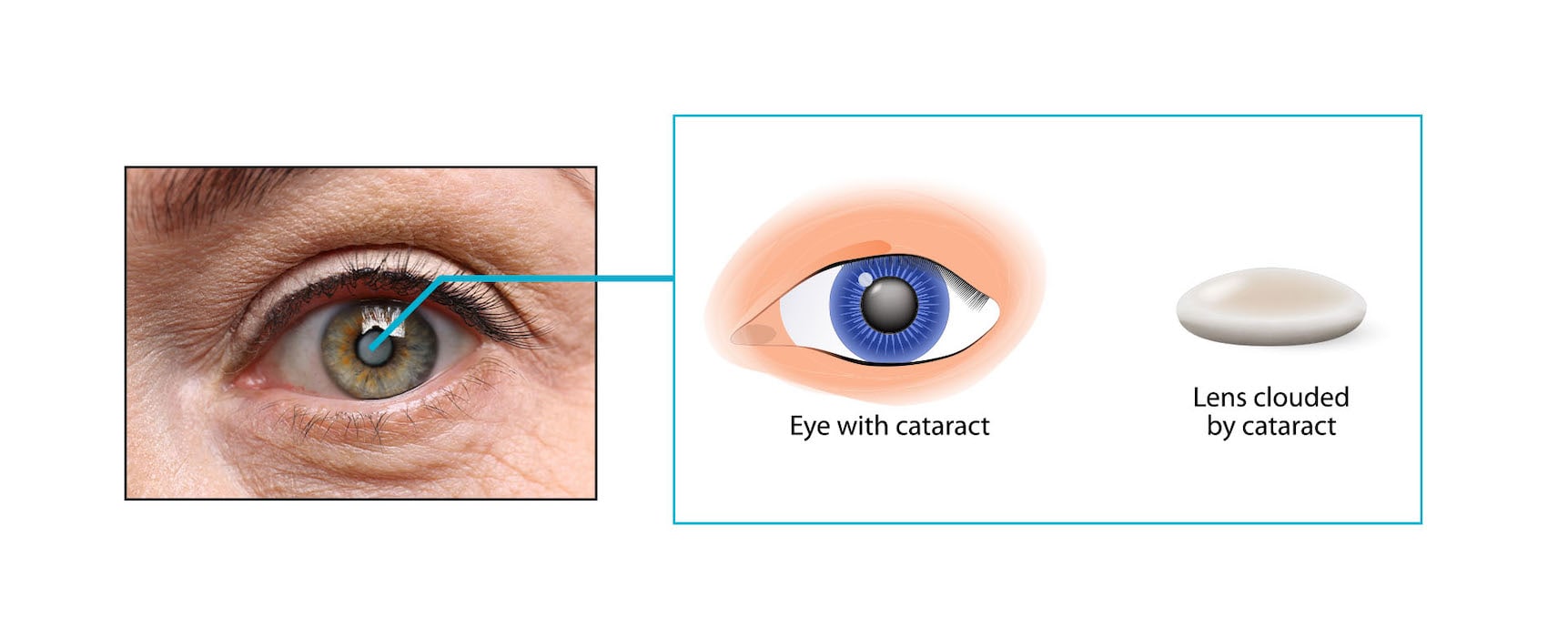 Cataract Surgery Singapore