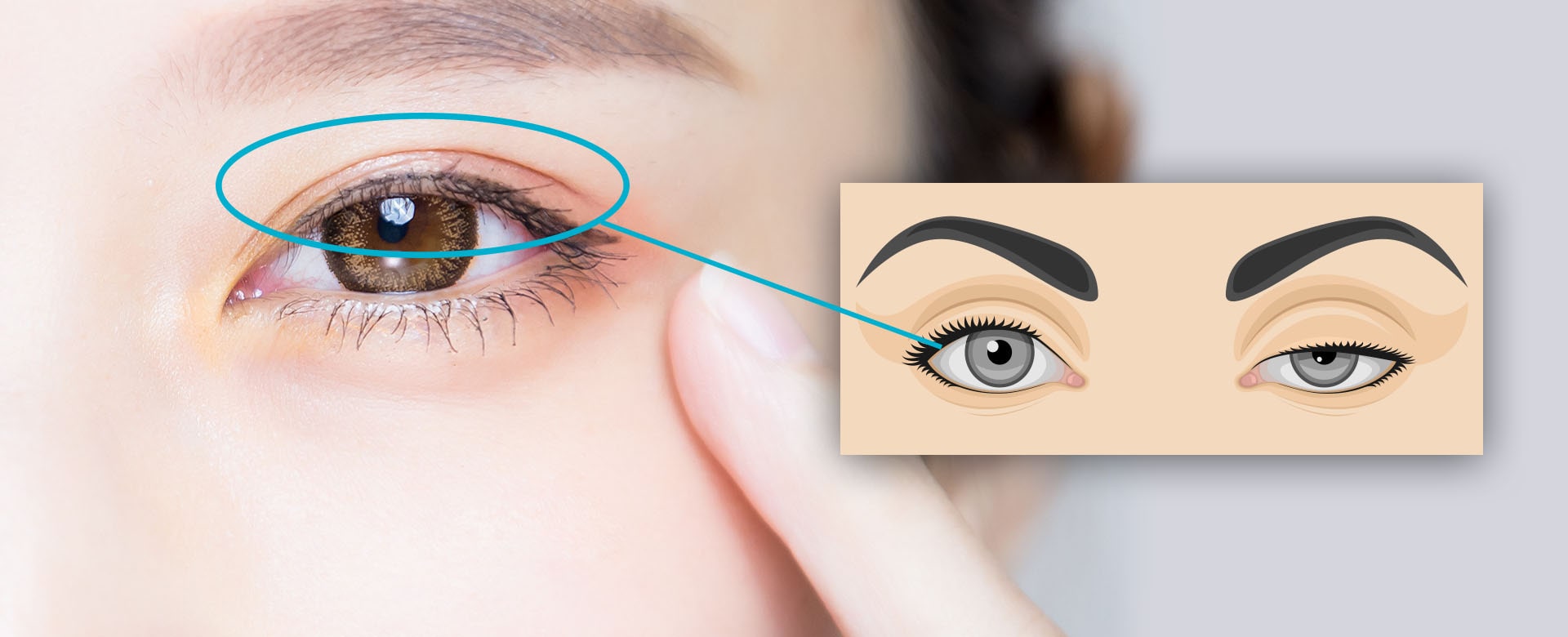 Ptosis Surgery Singapore Treatments For Droopy Eyelids For Clear