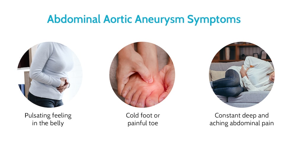 Abdominal Aortic Aneurysm