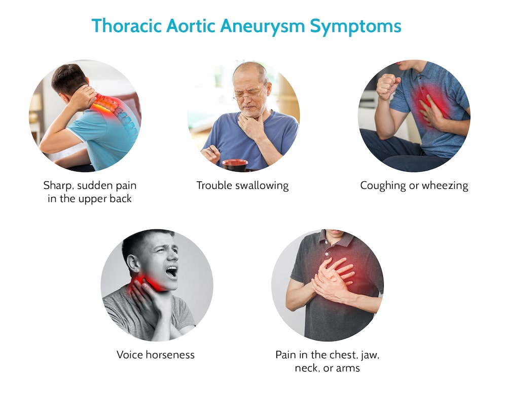 Thoracic Aortic Aneurysm