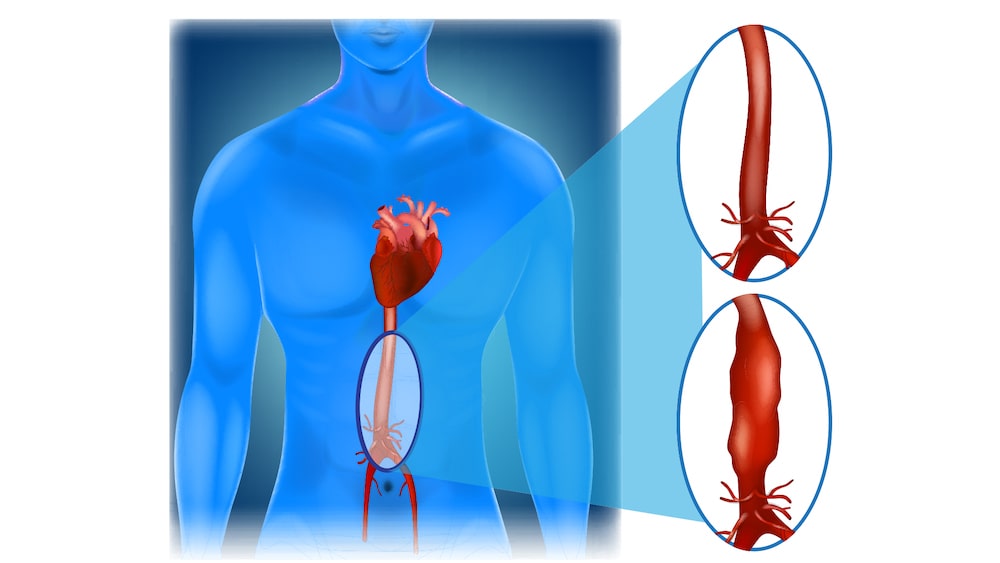 What Is Aortic Aneurysm