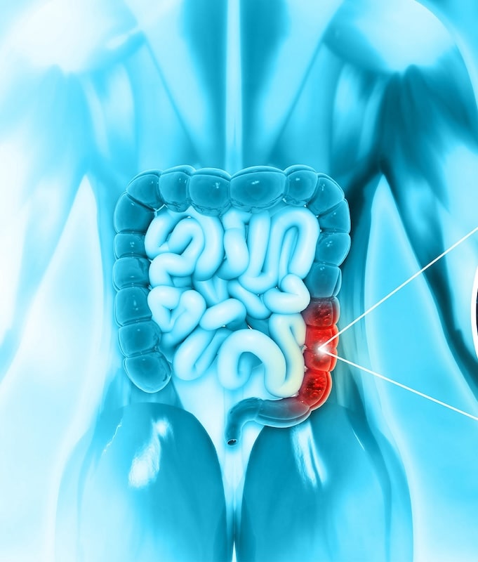 Colorectal cancers image