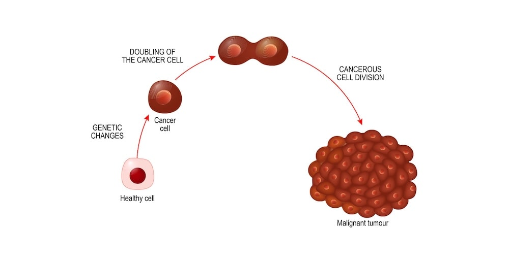 Four Stages of Cancer